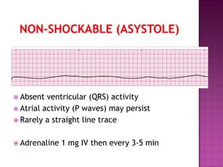  Absent ventricular (QRS) activity
 Atrial activity (P waves) may persist
 Rarely a straight line trace
 Adrenaline 1 mg IV then every 3-5 min
 