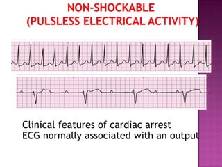 Clinical features of cardiac arrest
ECG normally associated with an output
 