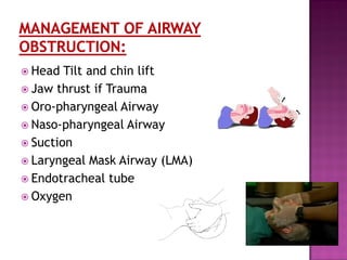  Head Tilt and chin lift
 Jaw thrust if Trauma
 Oro-pharyngeal Airway
 Naso-pharyngeal Airway
 Suction
 Laryngeal Mask Airway (LMA)
 Endotracheal tube
 Oxygen
 