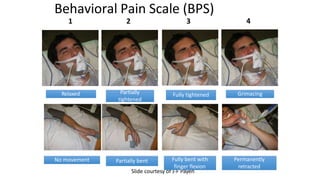 Behavioral Pain Scale (BPS)
1 2 3 4
Slide courtesy of J-F Payen
Relaxed Partially
tightened
Fully tightened Grimacing
No movement Partially bent Fully bent with
finger flexion
Permanently
retracted
 