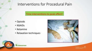 Interventions for Procedural Pain
• Opioids
• NSAIDs
• Ketamine
• Relaxation techniques
Time interventions to peak effect!
 
