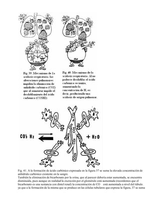 Fig. 41. A la formación de ácido carbónico expresada en la figura 37 se suma la elevada concentración de 
anhídrido carbónico existente en la sangre. 
También la eliminación de bicarbonato por la orina, que al parecer debería estar aumentada, se encuentra 
disminuida, pues aunque en realidad la excreción por el glomérulo está aumentada (recordemos que el 
bicarbonato es una sustancia con dintel renal) la concentración de CO está aumentada a nivel del túbulo. 
ya que a la formación de la misma que se produce en las células tubulares que expresa la figura, 37 se suma 
 