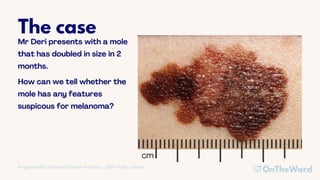 ABCDEs of Melanoma PowerPoint PPT