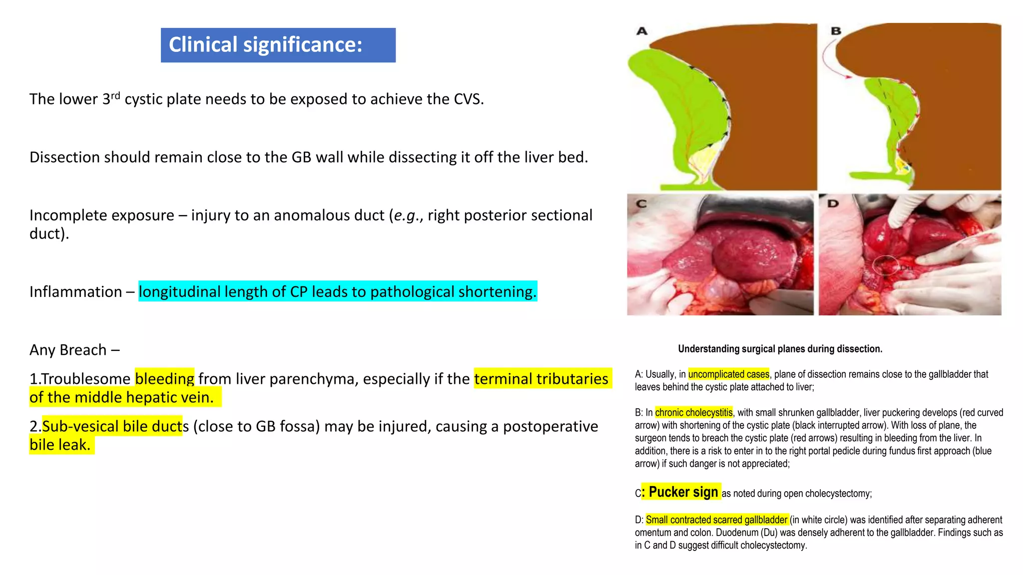 Clinical significance:
The lower 3rd cystic plate needs to be exposed to achieve the CVS.
Dissection should remain close to the GB wall while dissecting it off the liver bed.
Incomplete exposure – injury to an anomalous duct (e.g., right posterior sectional
duct).
Inflammation – longitudinal length of CP leads to pathological shortening.
Any Breach –
1.Troublesome bleeding from liver parenchyma, especially if the terminal tributaries
of the middle hepatic vein.
2.Sub-vesical bile ducts (close to GB fossa) may be injured, causing a postoperative
bile leak.
Understanding surgical planes during dissection.
A: Usually, in uncomplicated cases, plane of dissection remains close to the gallbladder that
leaves behind the cystic plate attached to liver;
B: In chronic cholecystitis, with small shrunken gallbladder, liver puckering develops (red curved
arrow) with shortening of the cystic plate (black interrupted arrow). With loss of plane, the
surgeon tends to breach the cystic plate (red arrows) resulting in bleeding from the liver. In
addition, there is a risk to enter in to the right portal pedicle during fundus first approach (blue
arrow) if such danger is not appreciated;
C: Pucker sign as noted during open cholecystectomy;
D: Small contracted scarred gallbladder (in white circle) was identified after separating adherent
omentum and colon. Duodenum (Du) was densely adherent to the gallbladder. Findings such as
in C and D suggest difficult cholecystectomy.
 