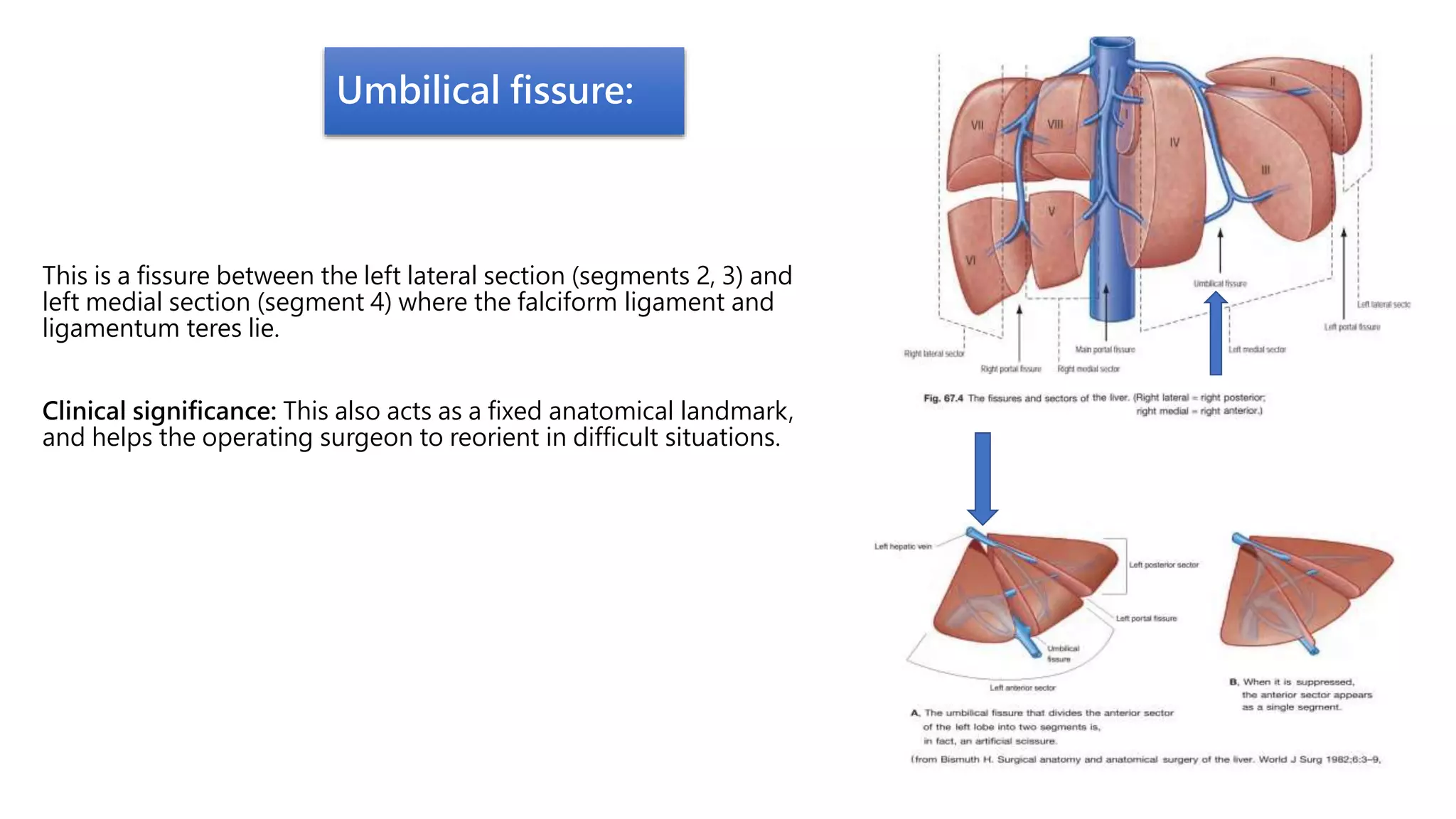 Umbilical fissure:
This is a fissure between the left lateral section (segments 2, 3) and
left medial section (segment 4) where the falciform ligament and
ligamentum teres lie.
Clinical significance: This also acts as a fixed anatomical landmark,
and helps the operating surgeon to reorient in difficult situations.
 