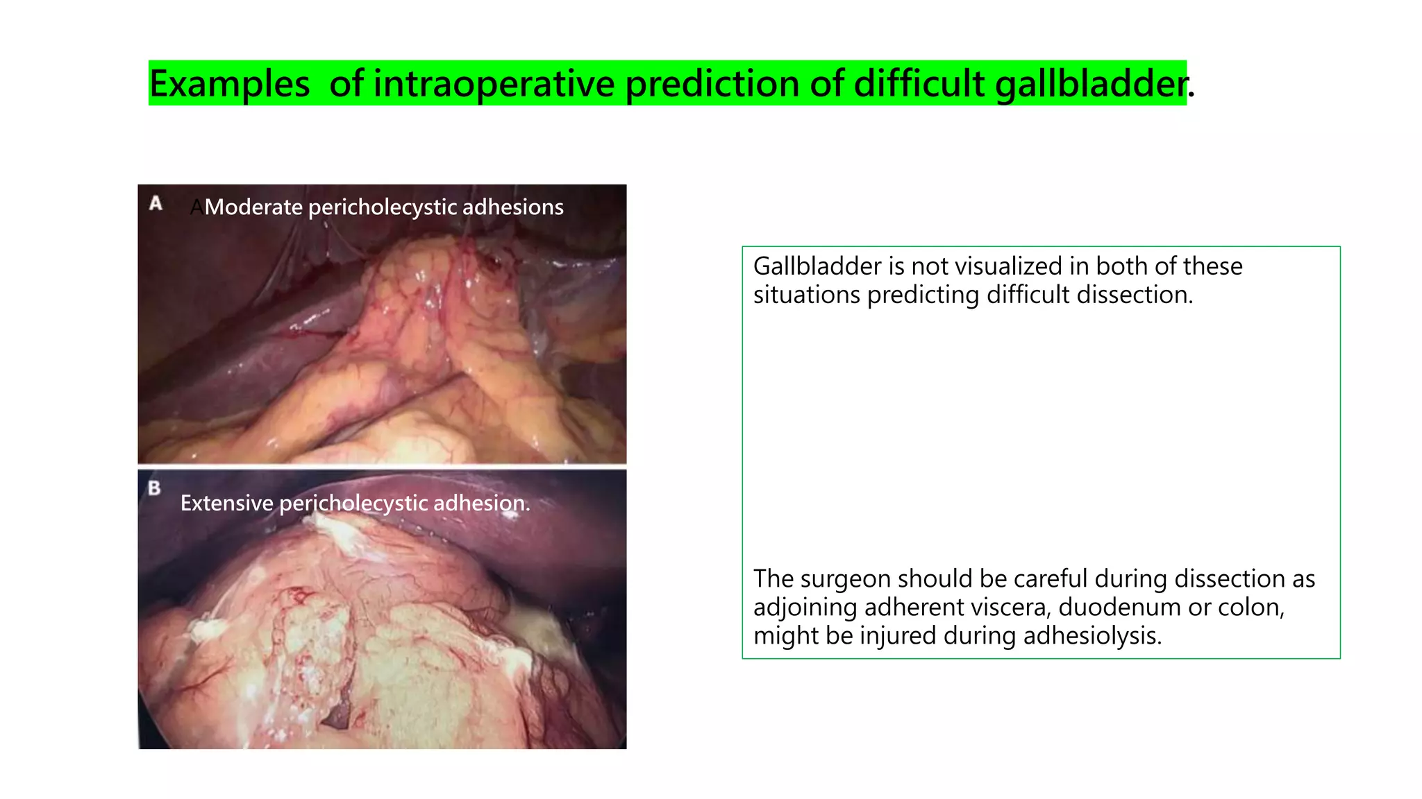 Gallbladder is not visualized in both of these
situations predicting difficult dissection.
The surgeon should be careful during dissection as
adjoining adherent viscera, duodenum or colon,
might be injured during adhesiolysis.
AModerate pericholecystic adhesions
Extensive pericholecystic adhesion.
Examples of intraoperative prediction of difficult gallbladder.
 
