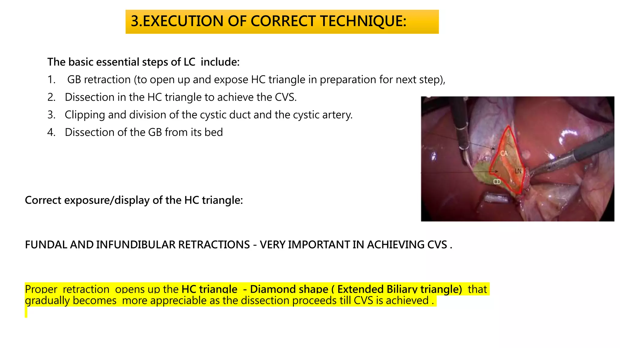 3.EXECUTION OF CORRECT TECHNIQUE:
The basic essential steps of LC include:
1. GB retraction (to open up and expose HC triangle in preparation for next step),
2. Dissection in the HC triangle to achieve the CVS.
3. Clipping and division of the cystic duct and the cystic artery.
4. Dissection of the GB from its bed
Correct exposure/display of the HC triangle:
FUNDAL AND INFUNDIBULAR RETRACTIONS - VERY IMPORTANT IN ACHIEVING CVS .
Proper retraction opens up the HC triangle - Diamond shape ( Extended Biliary triangle) that
gradually becomes more appreciable as the dissection proceeds till CVS is achieved .
 