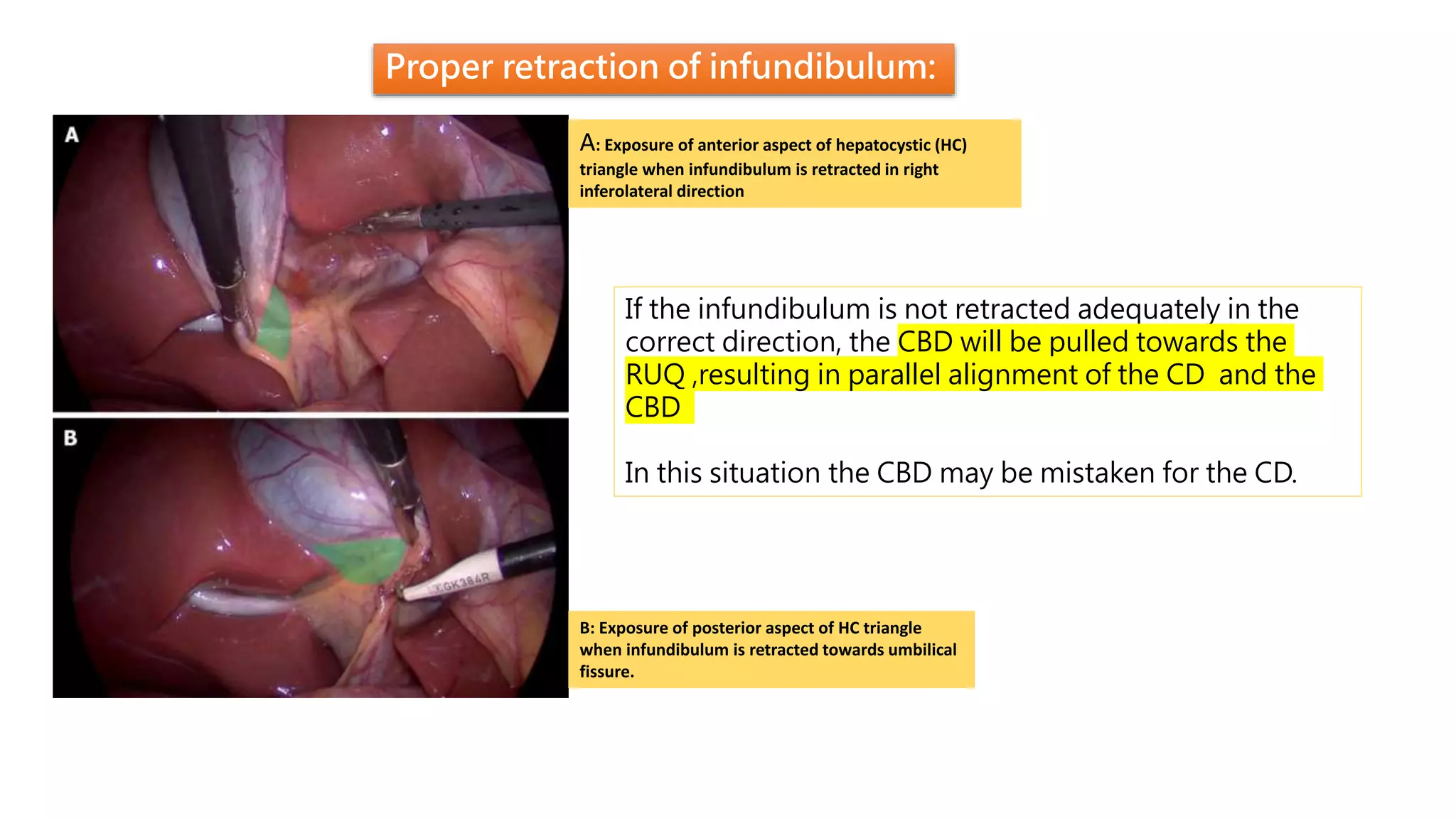 Proper retraction of infundibulum:
A: Exposure of anterior aspect of hepatocystic (HC)
triangle when infundibulum is retracted in right
inferolateral direction
B: Exposure of posterior aspect of HC triangle
when infundibulum is retracted towards umbilical
fissure.
If the infundibulum is not retracted adequately in the
correct direction, the CBD will be pulled towards the
RUQ ,resulting in parallel alignment of the CD and the
CBD
In this situation the CBD may be mistaken for the CD.
 