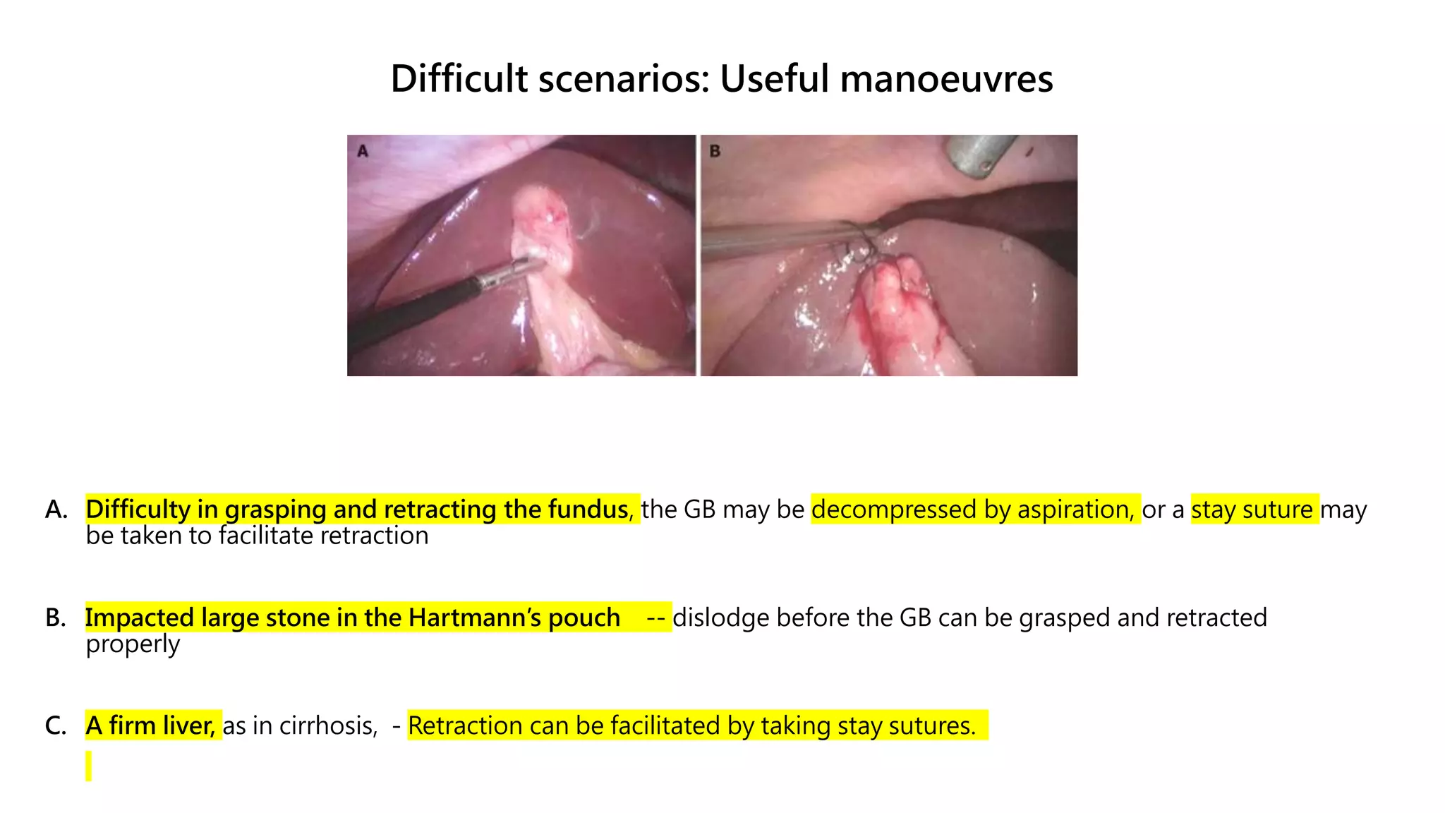 Difficult scenarios: Useful manoeuvres
A. Difficulty in grasping and retracting the fundus, the GB may be decompressed by aspiration, or a stay suture may
be taken to facilitate retraction
B. Impacted large stone in the Hartmann’s pouch -- dislodge before the GB can be grasped and retracted
properly
C. A firm liver, as in cirrhosis, - Retraction can be facilitated by taking stay sutures.
 