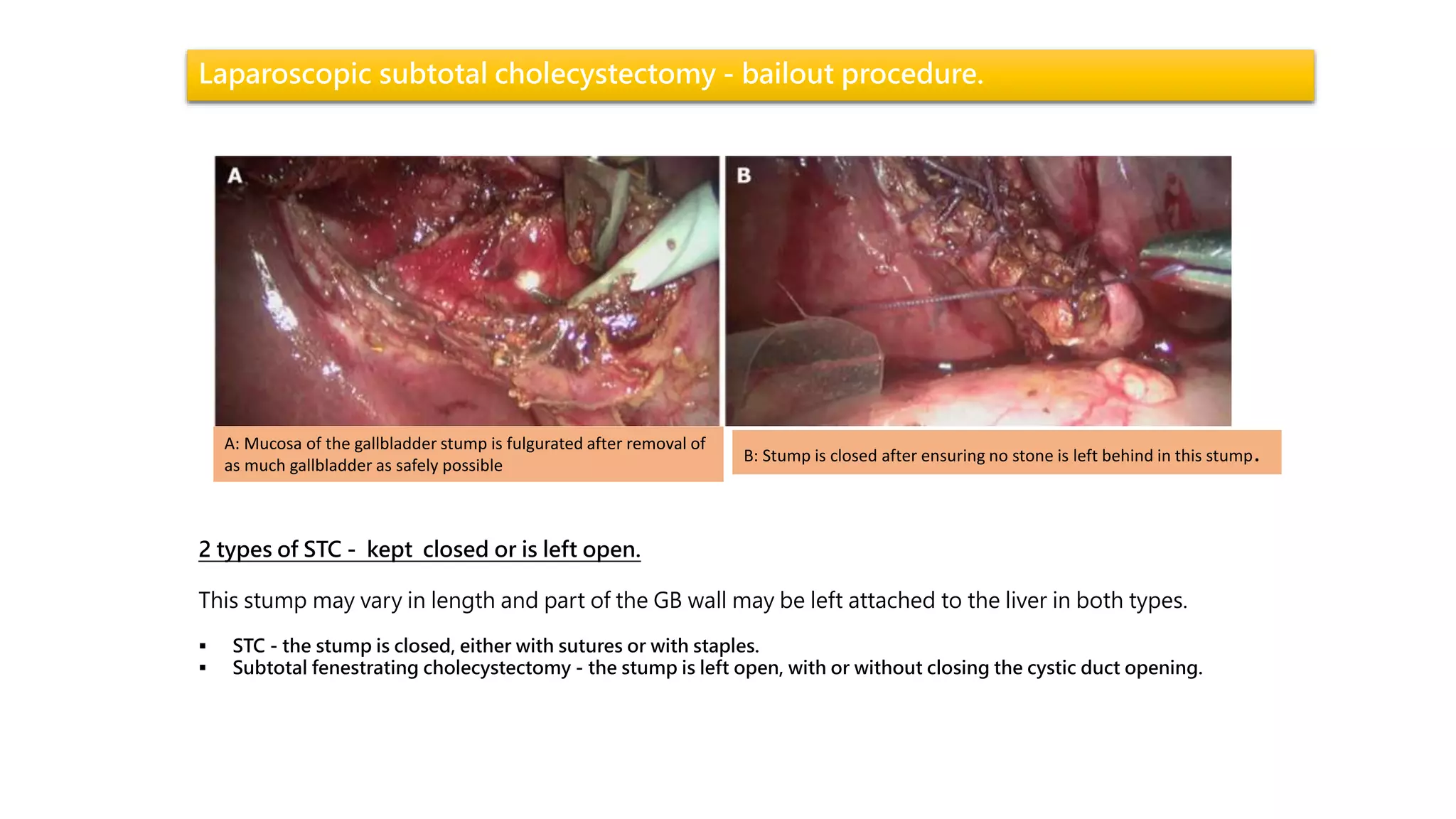 Laparoscopic subtotal cholecystectomy - bailout procedure.
A: Mucosa of the gallbladder stump is fulgurated after removal of
as much gallbladder as safely possible
B: Stump is closed after ensuring no stone is left behind in this stump.
2 types of STC - kept closed or is left open.
This stump may vary in length and part of the GB wall may be left attached to the liver in both types.
 STC - the stump is closed, either with sutures or with staples.
 Subtotal fenestrating cholecystectomy - the stump is left open, with or without closing the cystic duct opening.
 