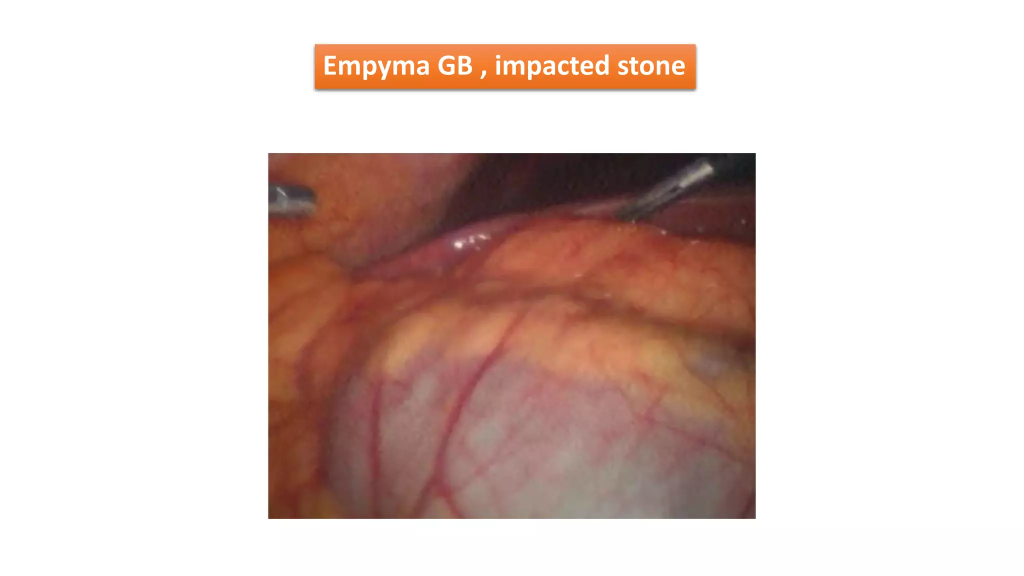 Empyma GB , impacted stone
 