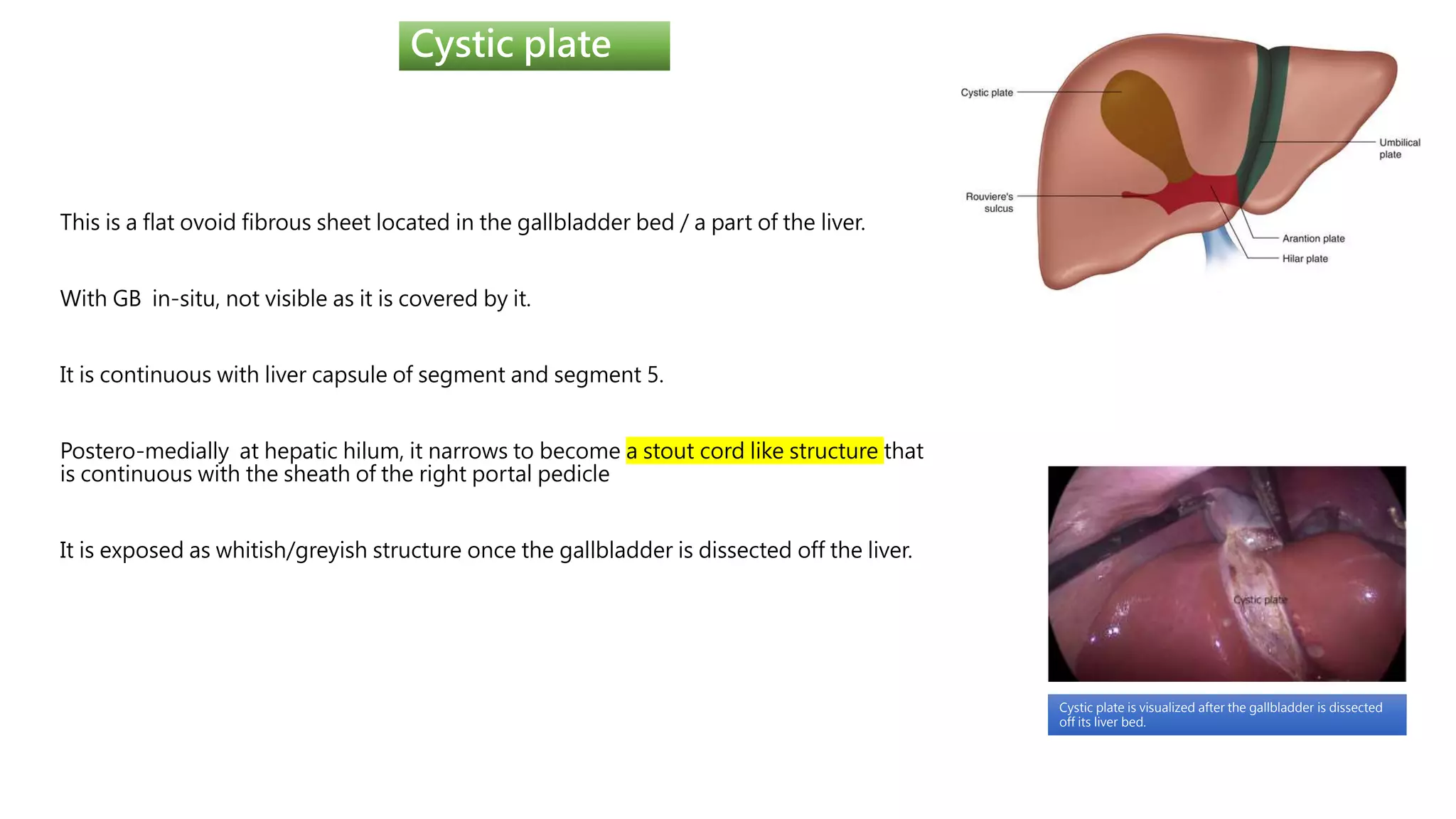 Cystic plate
This is a flat ovoid fibrous sheet located in the gallbladder bed / a part of the liver.
With GB in-situ, not visible as it is covered by it.
It is continuous with liver capsule of segment and segment 5.
Postero-medially at hepatic hilum, it narrows to become a stout cord like structure that
is continuous with the sheath of the right portal pedicle
It is exposed as whitish/greyish structure once the gallbladder is dissected off the liver.
Cystic plate is visualized after the gallbladder is dissected
off its liver bed.
 