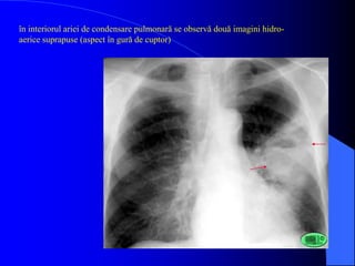 ABCES
PULMONAR
IN FAZA CRONICA
“CHIRURGICAL”
 