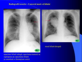 Radiografii toracice - Pneumonia canceroasă
opacitate de tip pneumonic lob inferior drept
 