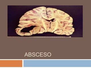 ABSCESO
 