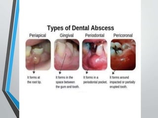 Periodontal Abcess classification diagnosis etc .pptx
