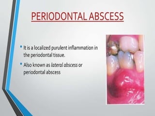 Periodontal Abcess classification diagnosis etc .pptx