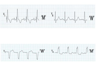 ABC of Electrocardiogram(ECG) | PPTX