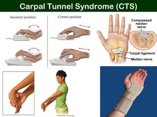 Carpal Tunnel Syndrome (CTS)
 