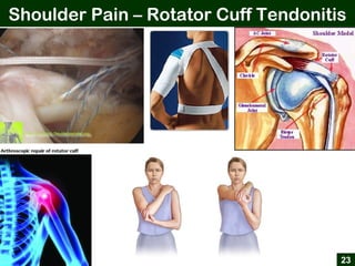 Shoulder Pain – Rotator Cuff Tendonitis
23
 