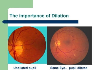 The importance of Dilation Undilated pupil Same Eye--  pupil dilated 