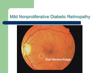 Mild Nonproliferative Diabetic Retinopathy Dot Hemorrhage 