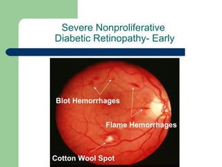 Severe Nonproliferative  Diabetic Retinopathy- Early Blot Hemorrhages Cotton Wool Spot Flame Hemorrhages 
