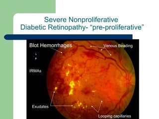 Severe Nonproliferative  Diabetic Retinopathy- “pre-proliferative” Blot Hemorrhages Exudates Venous Beading IRMAs Looping capillaries 