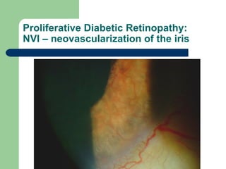 Proliferative Diabetic Retinopathy: NVI – neovascularization of the iris 