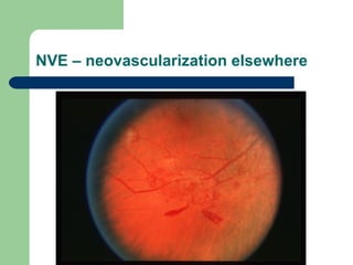 NVE – neovascularization elsewhere 
