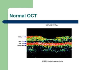 Normal OCT 
