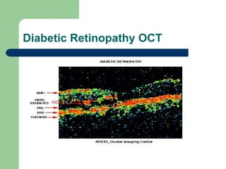 Diabetic Retinopathy OCT 