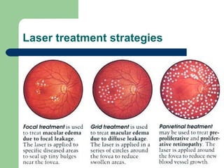 Laser treatment strategies 