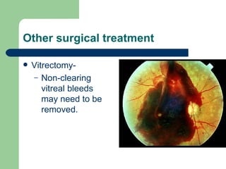 Other surgical treatment Vitrectomy-  Non-clearing vitreal bleeds may need to be removed. 