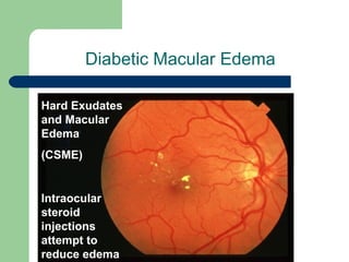 Diabetic Macular Edema Hard Exudates and Macular Edema (CSME) Intraocular steroid injections attempt to reduce edema 