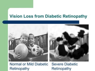 Vision Loss from Diabetic Retinopathy Normal or Mild Diabetic Retinopathy Severe Diabetic Retinopathy 