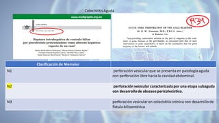 Clasificaciónde Niemeier
N1 perforación vesicularque se presenta en patologíaaguda
con perforación libre hacia la cavidadabdominal.
N2 perforación vesicular caracterizadapor una etapa subaguda
con desarrollode absceso pericolecístico.
N3 perforación vesicularen colecistitiscrónica con desarrollo de
fístula bilioentérica
ColecistitisAguda
 