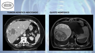 TUMOR HEPATICO ABSCEDADO QUISTE HIDATIDICO
 