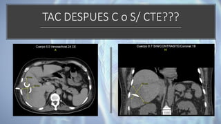 TAC DESPUES C o S/ CTE???
 