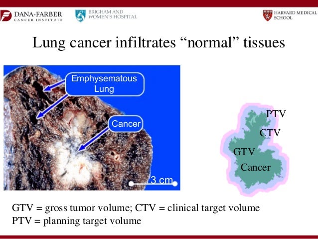 Dana farber lung cancer