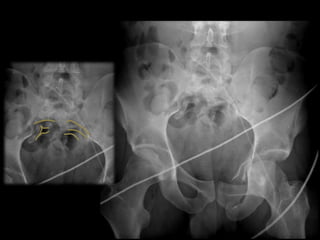 Trauma Image Interpretation of the Pelvis and Hip Radiographs: Using ...