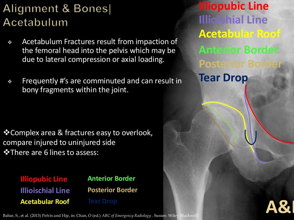 Trauma Image Interpretation of the Pelvis and Hip Radiographs: Using…