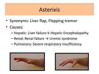 Asterixis
• Synonyms: Liver flap, Flepping tremor
• Causes:
– Hepatic: Liver failure→ Hepatic Encephalopathy
– Renal: Renal failure → Uremic syndrome
– Pulmonary: Severe respiratory insufficiency
 