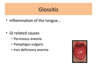 Glossitis
• inflammation of the tongue…
• GI related causes
– Pernisious anemia
– Pemphigus vulgaris
– Iron deficiency anemia
 