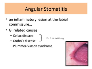 Angular Stomatitis
• an inflammatory lesion at the labial
commissure…
• GI related causes:
– Celiac disease
– Crohn’s disease
– Plummer-Vinson syndrome
Fe, B vit. deficiency
 
