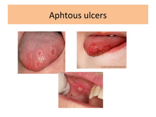 Aphtous ulcers
 