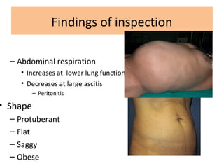Findings of inspection
– Abdominal respiration
• Increases at lower lung function
• Decreases at large ascitis
– Peritonitis
• Shape
– Protuberant
– Flat
– Saggy
– Obese
 