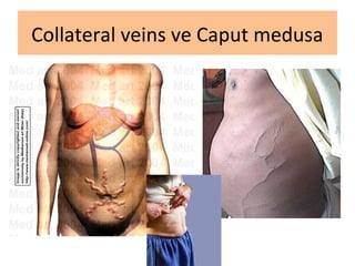 Collateral veins ve Caput medusa
 