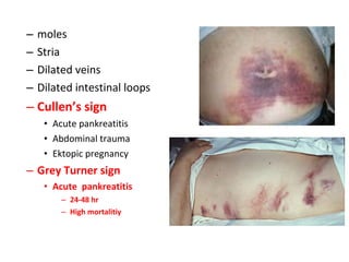 – moles
– Stria
– Dilated veins
– Dilated intestinal loops
– Cullen’s sign
• Acute pankreatitis
• Abdominal trauma
• Ektopic pregnancy
– Grey Turner sign
• Acute pankreatitis
– 24-48 hr
– High mortalitiy
 