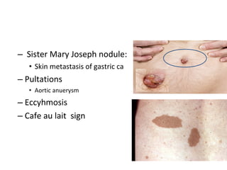– Sister Mary Joseph nodule:
• Skin metastasis of gastric ca
– Pultations
• Aortic anuerysm
– Eccyhmosis
– Cafe au lait sign
 